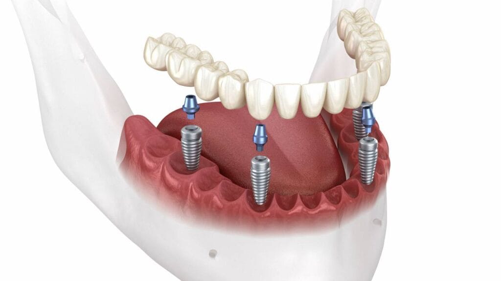 Sakarya Elbirlik Diş Polikliniği tam dişsiz çeneler için 4 implant üzerine sabitlenen hibrit protez animasyonu video kapak görseli.