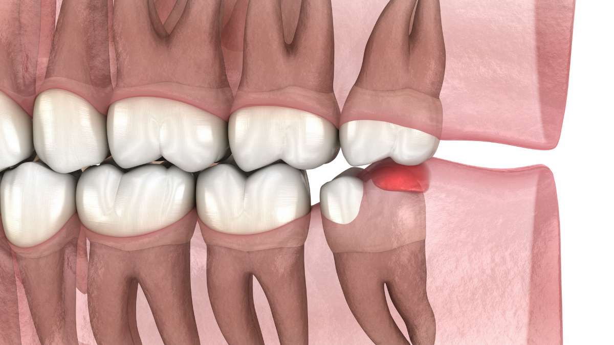 Gömülü veya yarı gömülü 20'lik yaş dişlerinin (akıl dişi) neden olduğu lokal diş eti şişmesi (perikoronitis) ve ağrı durumunun klinik muayenesi
