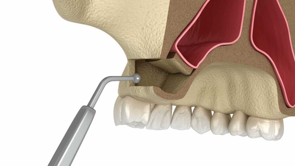 Sakarya Elbirlik Diş Polikliniği üst çene kemik yetersizliğinde uygulanan açık sinüs lifting ameliyatı ve kemik grefti yerleştirme 3D animasyonu video kapak görseli.