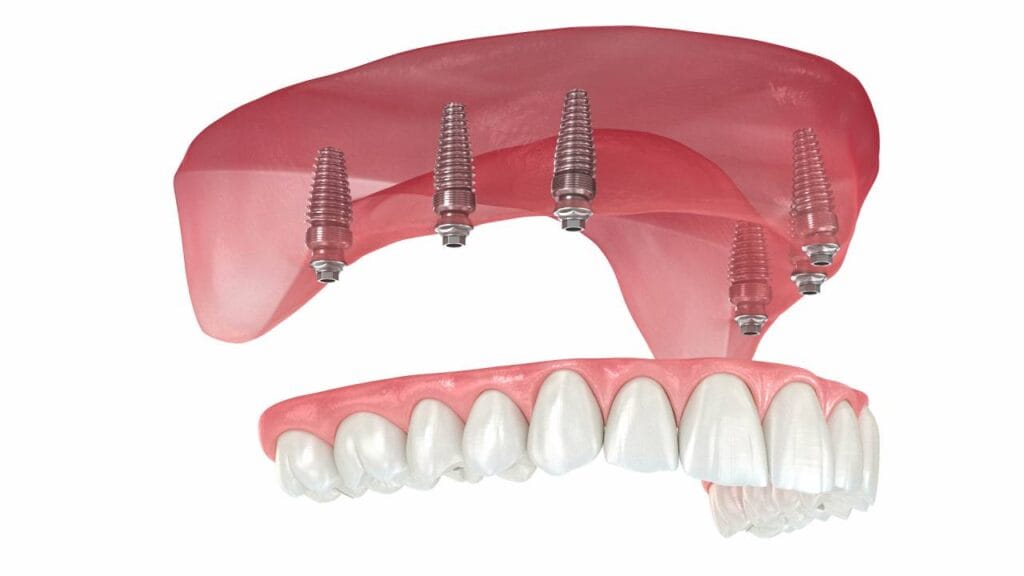 Sakarya Elbirlik Diş Polikliniği üst çene kemiğine yerleştirilen 6 adet titanyum implant ve üzerine vidalanan sabit porselen dişlerin 3D animasyonu video kapak görseli.