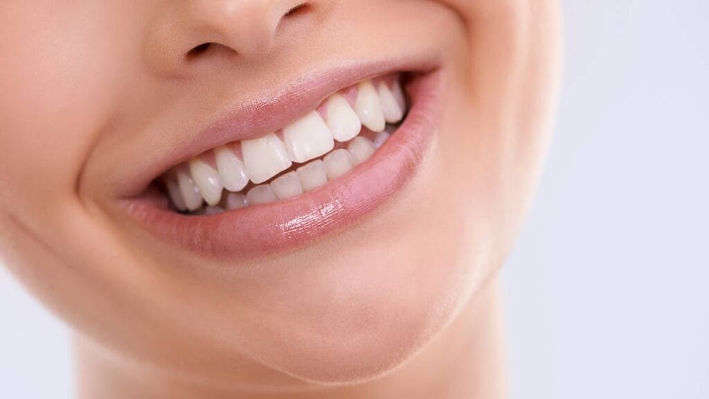 Sakarya diş kliniğinde diş yüzeyinden aşındırma yapmadan (prepsiz), kompozit dolgu materyali ile tek seansta uygulanan bonding estetik gülüş tasarımı.