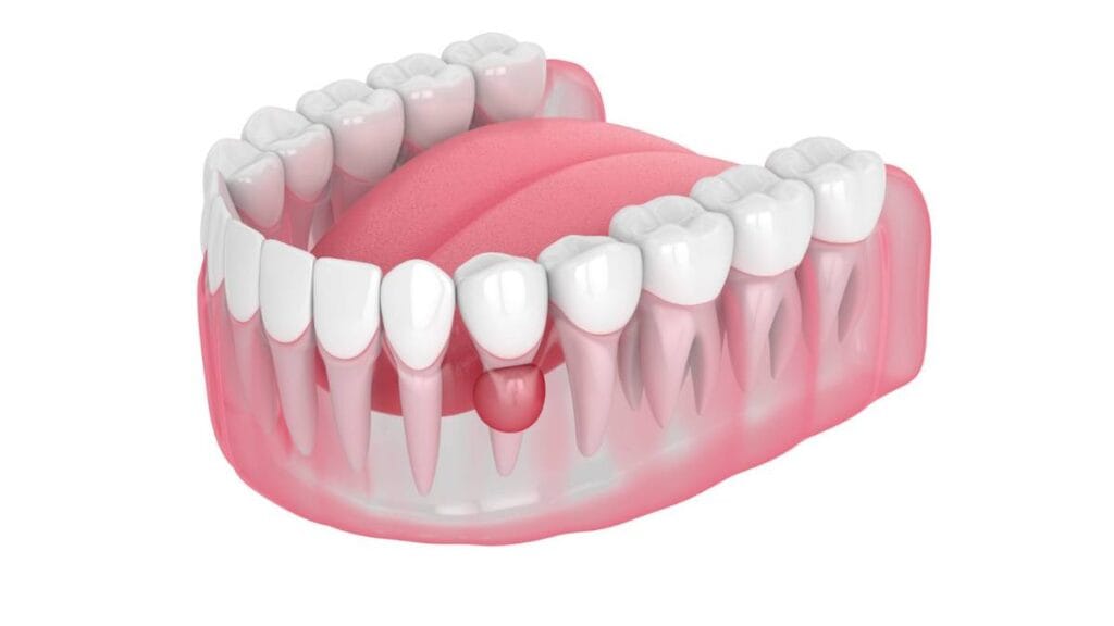 Sakarya çene cerrahisi kliniğinde tedavi edilen, diş kökü ucunda gelişmiş enfeksiyon (apse) kaynaklı çene kistinin anatomik illüstrasyonu.