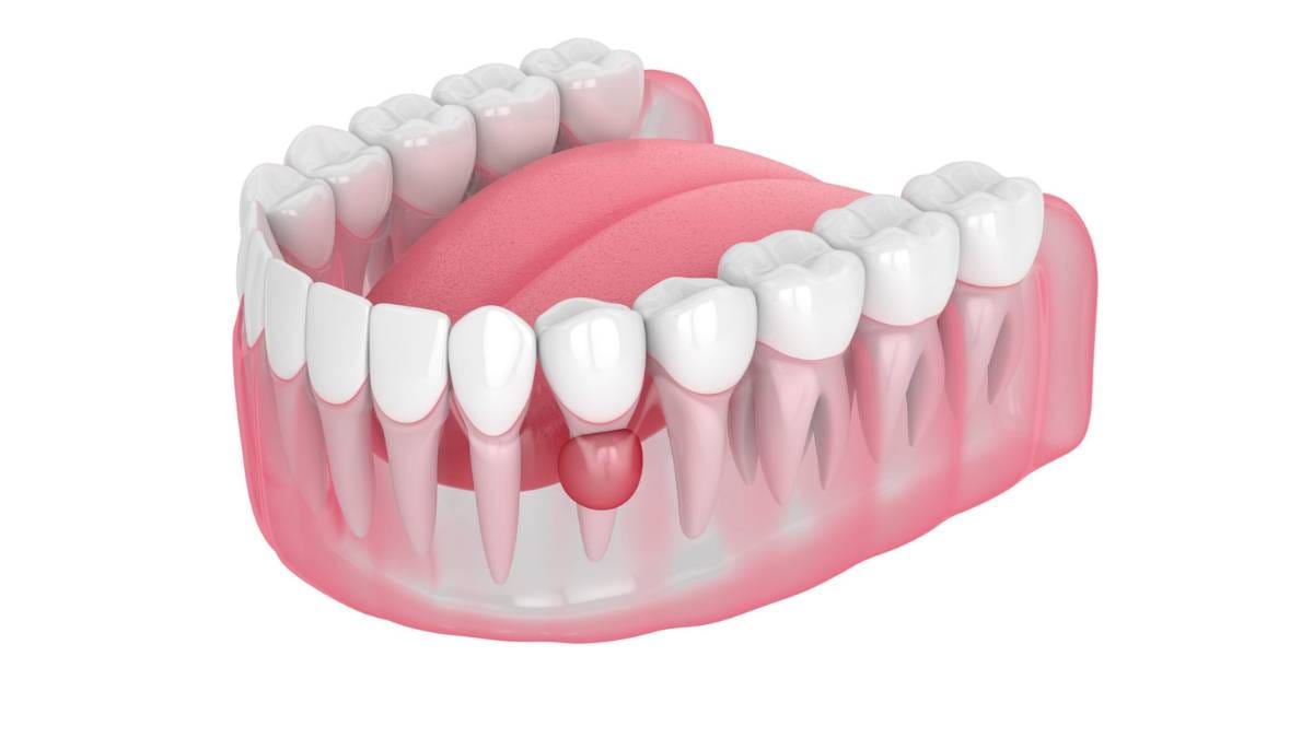 Sakarya çene cerrahisi kliniğinde tedavi edilen diş kökü ucunda gelişmiş çene kistinin anatomik illüstrasyonu