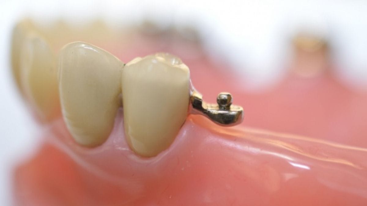 Sakarya diş kliniğinde uygulanan, dışarıdan görünmeyen ve dişin arkasına gizlenen topuz (hassas bağlantı) mekanizmalı çıtçıtlı protez detayı