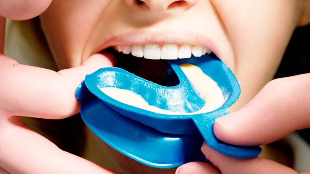 Sakarya çocuk diş hekimliğinde uygulanan koruyucu flor uygulaması ve çürük önleyici tedavi materyalleri