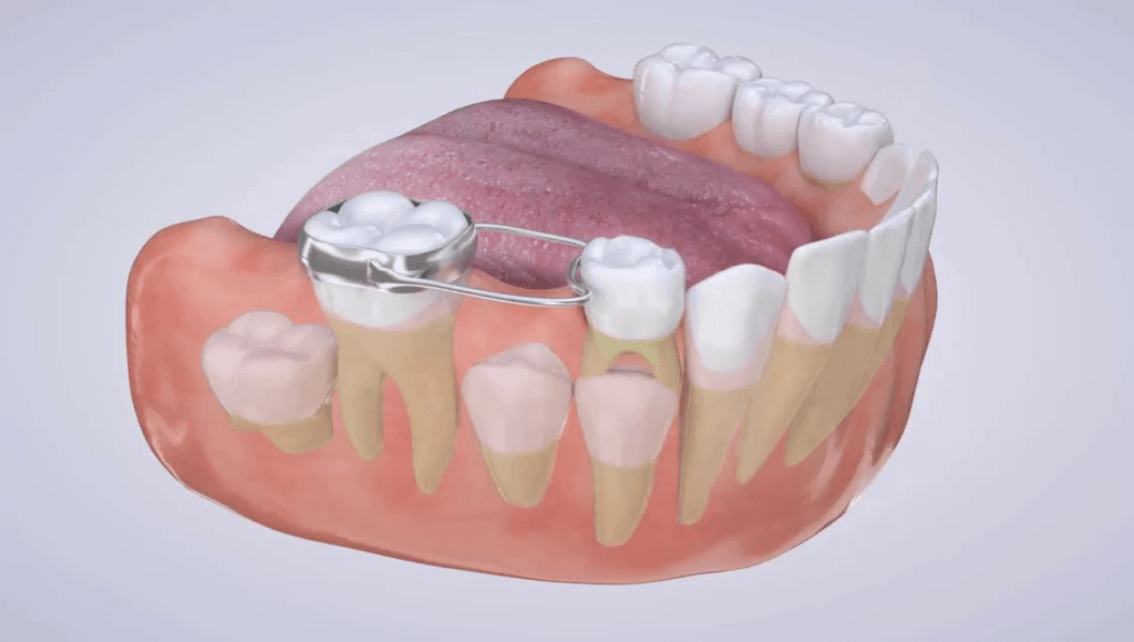 Erken çekilen süt dişinin yerini koruyan metal yer tutucu apareyinin 3D modellemesi ve video kapak resmi.