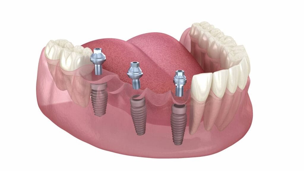 Sakarya Elbirlik Diş Polikliniği alt çenede eksik dişlerin yerine uygulanan 3 implant ve üzerine vidalanan porselen köprü animasyonu video kapak görseli.