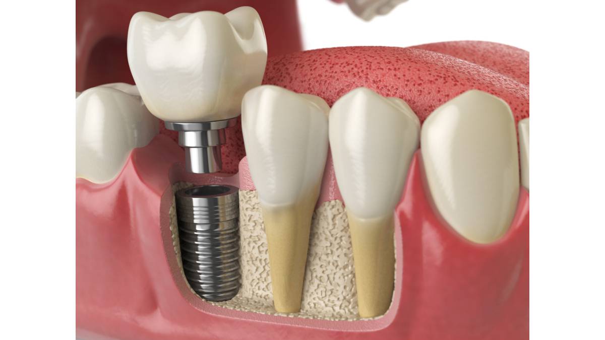 Çene kemiğine yerleştirilen yapay diş kökü (implant), bağlantı parçası (abutment) ve porselen kurondan oluşan dental implant anatomisi 3D modeli