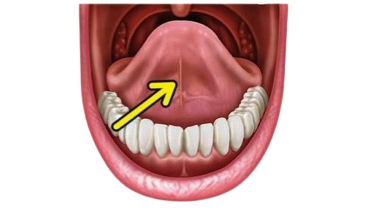 Sakarya frenektomi kliniğinde tanı konulan kısa dil bağı anatomik görünümü