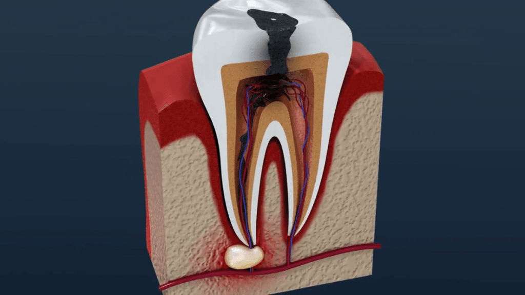 Sakarya diş kliniğinde tedavi edilen, mine tabakasından başlayıp diş sinirine kadar ilerleyen derin çürük ve kök ucu apsesi oluşumunu gösteren 3D medikal illüstrasyon.