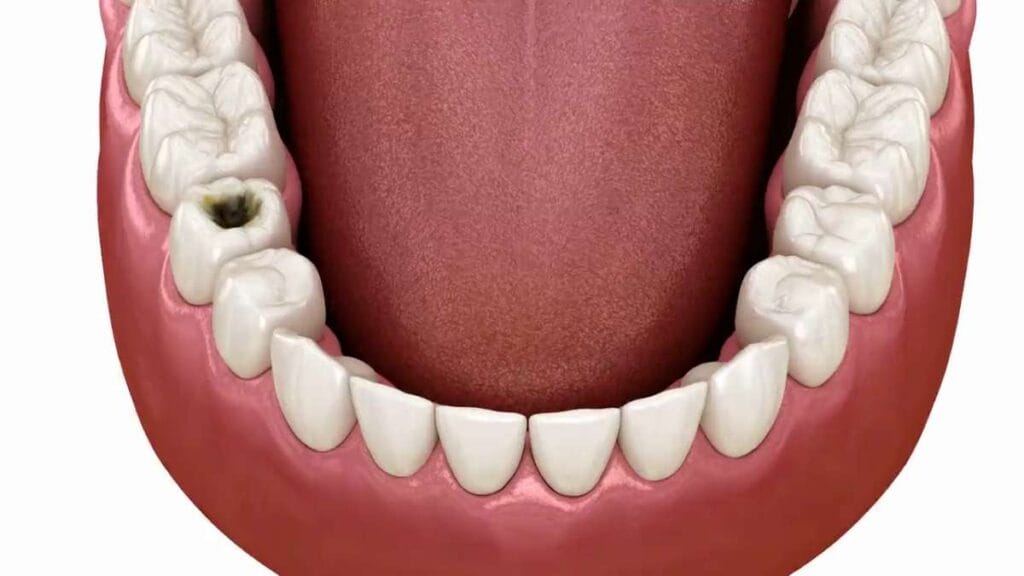 Sakarya diş kliniğinde çürük temizleme ve dolgu yapım aşamalarını detaylıca gösteren 3D medikal animasyonun kapak görseli.