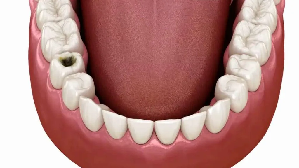 Sakarya diş kliniğinde çürük temizleme ve dolgu yapım aşamalarını detaylıca gösteren 3D medikal animasyonun kapak görseli.
