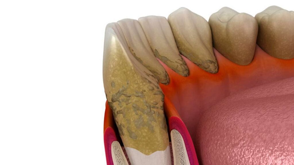Sakarya diş kliniğinde Flep operasyonu (diş eti ameliyatı) ile tedavi edilen derin diş eti cepleri ve kemik erimesi sürecini gösteren 3D animasyon kapağı.