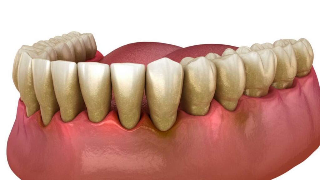 Sakarya diş kliniğinde diş eti çekilmesi ve kemik kaybı teşhisi için kullanılan, hastalığın ilerleyişini ve kök yüzeyinin açığa çıkmasını gösteren medikal animasyon kapağı.