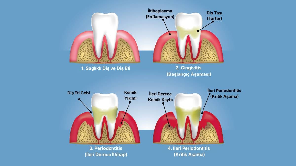 Sağlıklı diş eti dokusundan başlayarak, diş eti iltihabı (gingivitis), kemik kaybının başladığı periodontitis ve diş kaybına yol açan ileri periodontitis aşamalarını gösteren tıbbi şema
