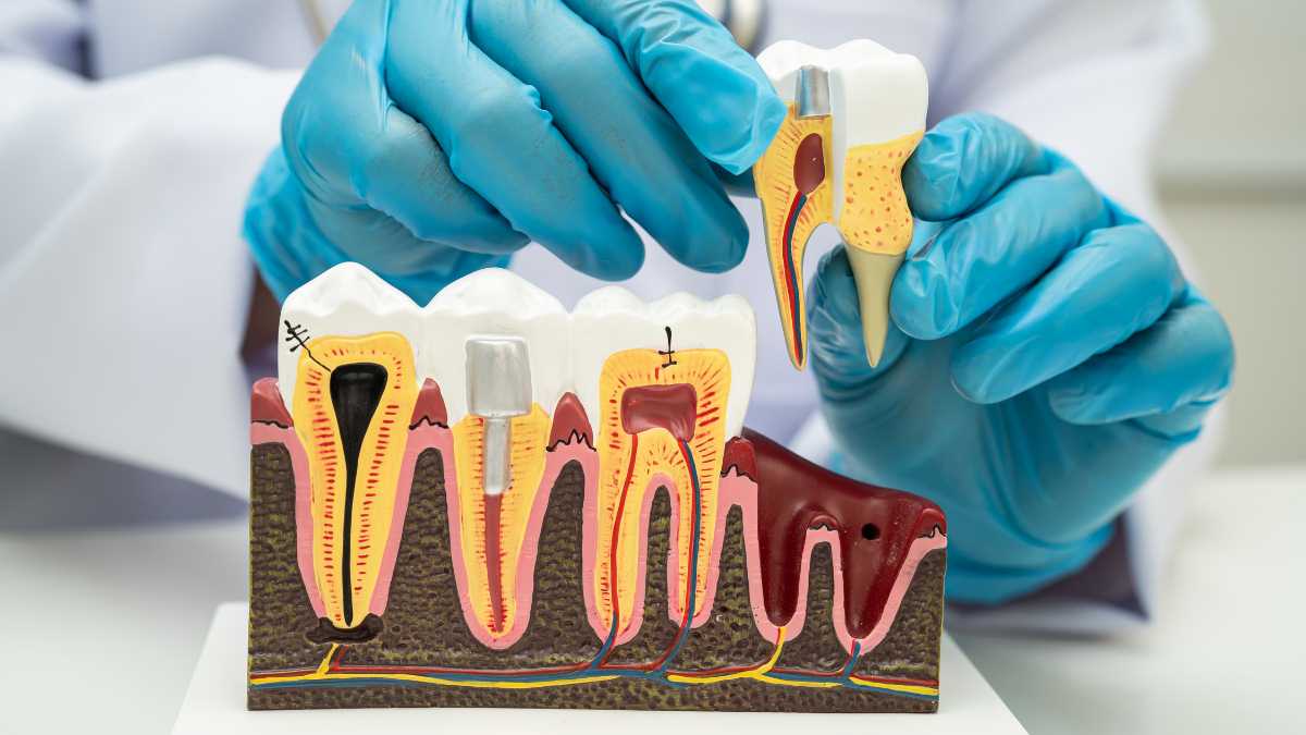 Sakarya diş kliniğinde sağlıklı diş eti ve kök yapısını gösteren model