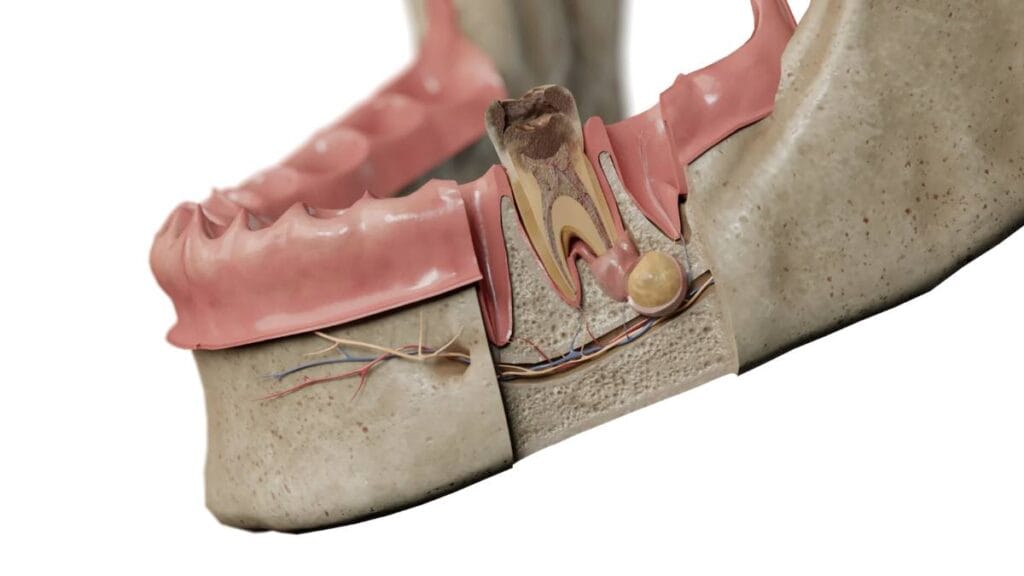 Sakarya ağız cerrahisi kliniğinde uygulanan apikal rezeksiyon (kök ucu kesimi) ameliyatını gerektiren, diş kökü ucunda oluşmuş kist ve iltihaplı dokunun anatomik kesiti.