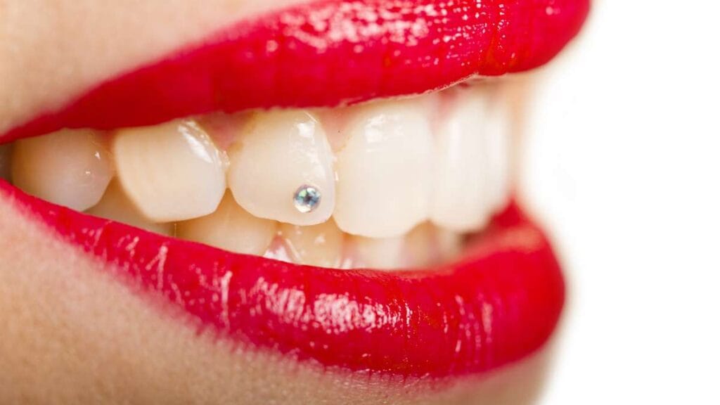 Sakarya estetik diş kliniğinde, diş yüzeyi delinmeden özel yapıştırıcılarla uygulanan, gülüşe ışıltı katan estetik diş mücevheri (kristali).