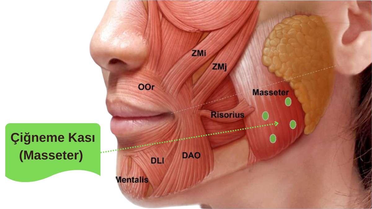Sakarya diş sıkma (bruksizm) tedavisinde hedef bölge olan Masseter çiğneme kasının anatomik görünümü