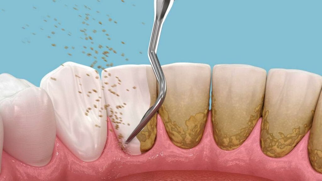 Sakarya diş kliniğinde ultrasonik scaler cihazı ile yapılan diş taşı temizliği ve plak uzaklaştırma işlemini gösteren 3D animasyon kapağı.