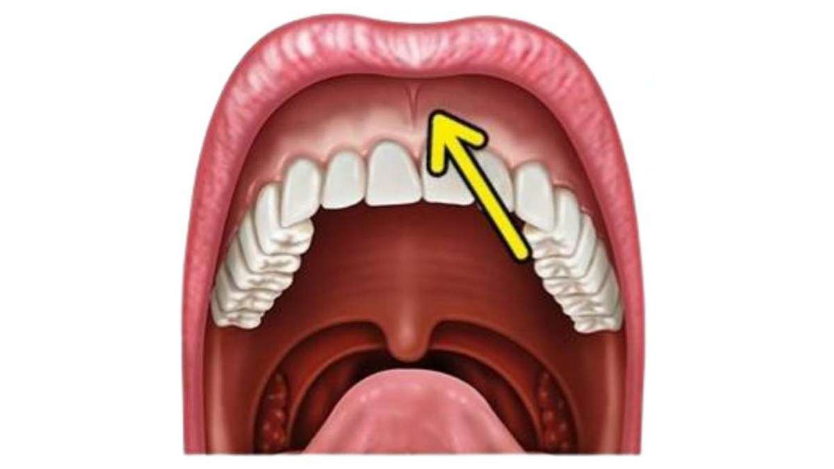 Sakarya diş hekimliğinde üst dudak bağının diş ayrıklığına neden olduğu durumun anatomik gösterimi