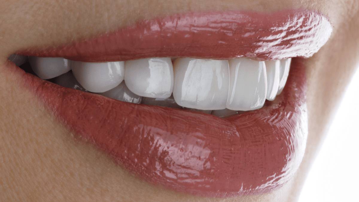 Sakarya estetik diş hekimliğinde ışık geçirgenliği yüksek Emax porselen kaplamalar