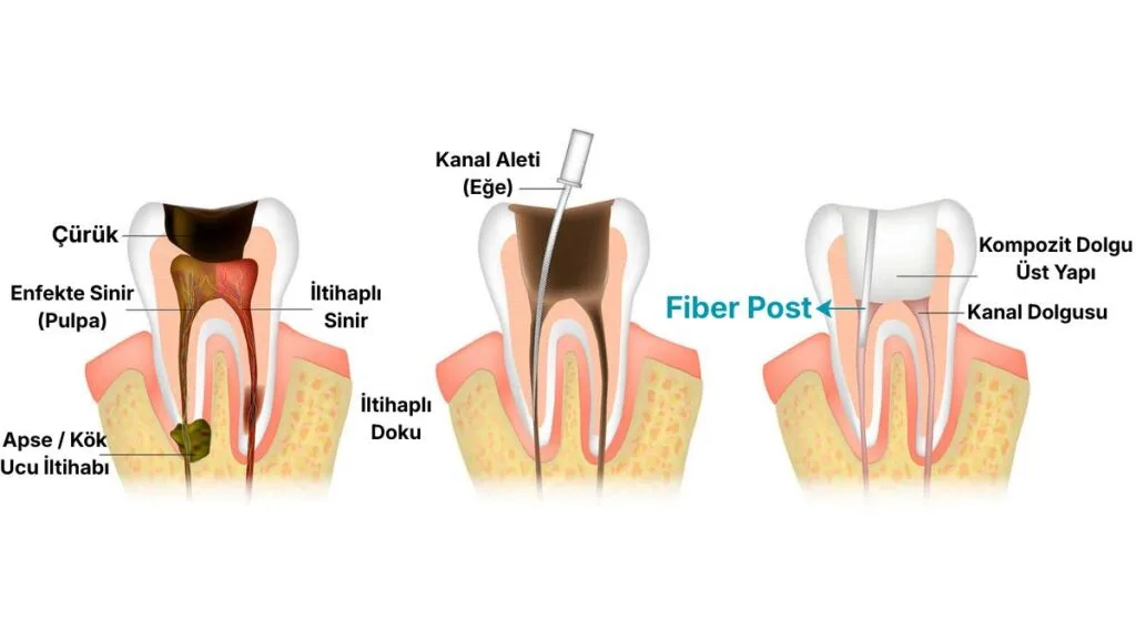 Sakarya diş kliniğinde, aşırı madde kaybı olan dişe kanal tedavisi sonrası uygulanan fiber post (güçlendirme çubuğu) ve dolgu restorasyon şeması.