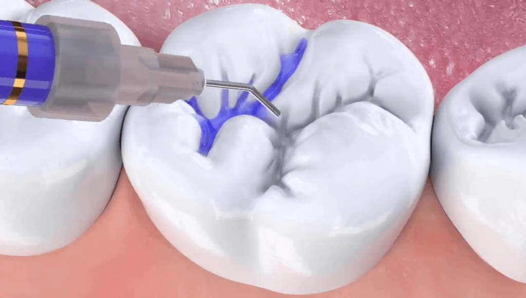 Çocuklarda azı dişlerini çürükten koruyan fissür örtücü (diş aşısı) uygulamasını gösteren 3D video kapak görseli.