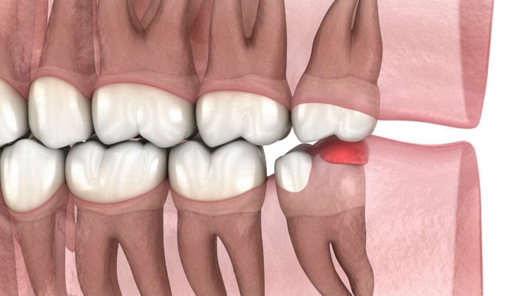 Sakarya çene cerrahisi kliniğinde gömülü 20'lik dişin (akıl dişi) diş etine yaptığı baskıyı ve oluşan iltihabı (kızarıklık) gösteren 3D animasyon video kapağı.