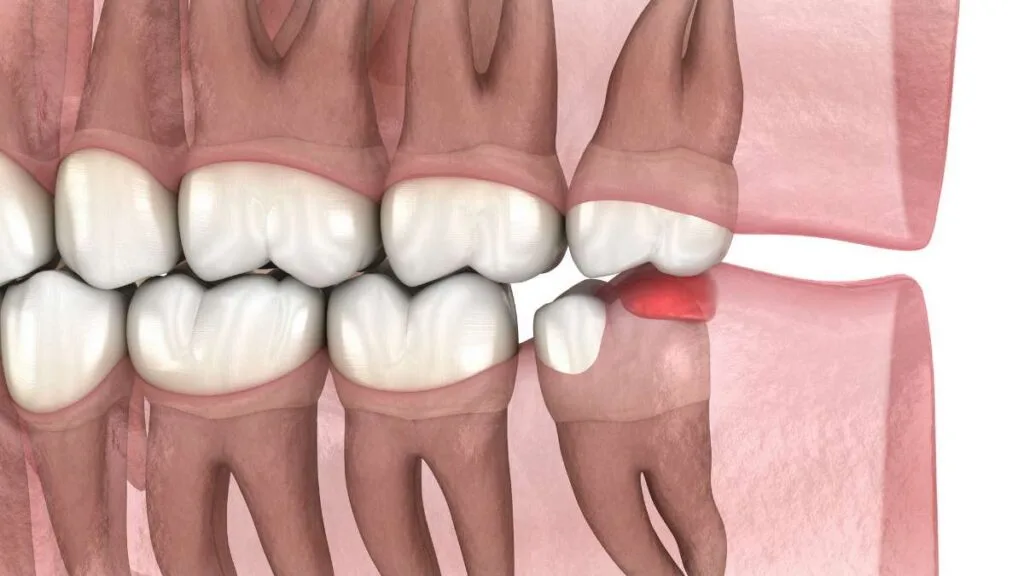 Sakarya çene cerrahisi kliniğinde gömülü 20'lik dişin (akıl dişi) diş etine yaptığı baskıyı ve oluşan iltihabı (kızarıklık) gösteren 3D animasyon video kapağı.