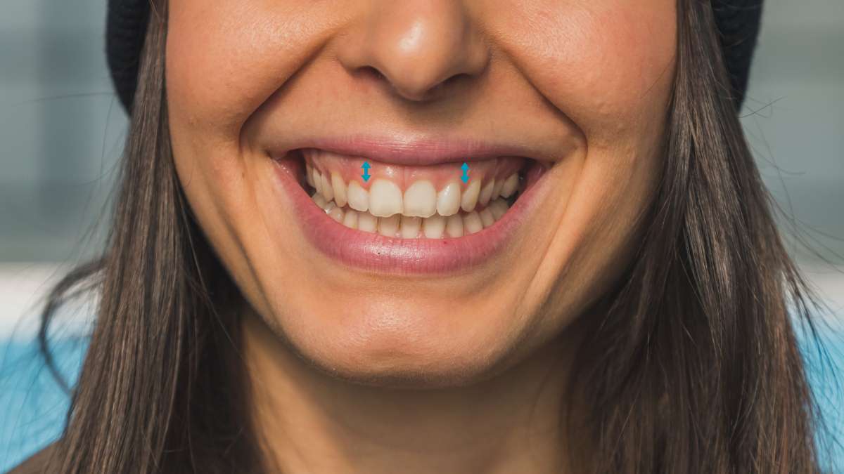 Sakarya diş kliniğinde Gummy Smile (diş eti gülüşü) sorununun oklarla gösterimi