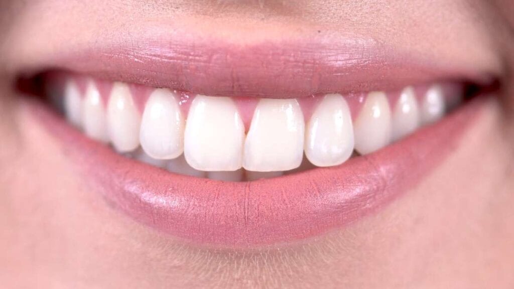 Sakarya estetik diş hekimliğinde uygulanan, doğal ışık yansımasına sahip zirkonyum ve lamine diş kaplamaların (Hollywood Smile) pürüzsüz ve beyaz görünümü.