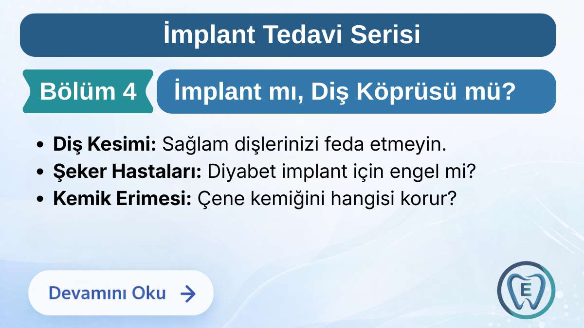 İmplant mı Yoksa Diş Köprüsü mü? Hangisi Daha Sağlıklı?