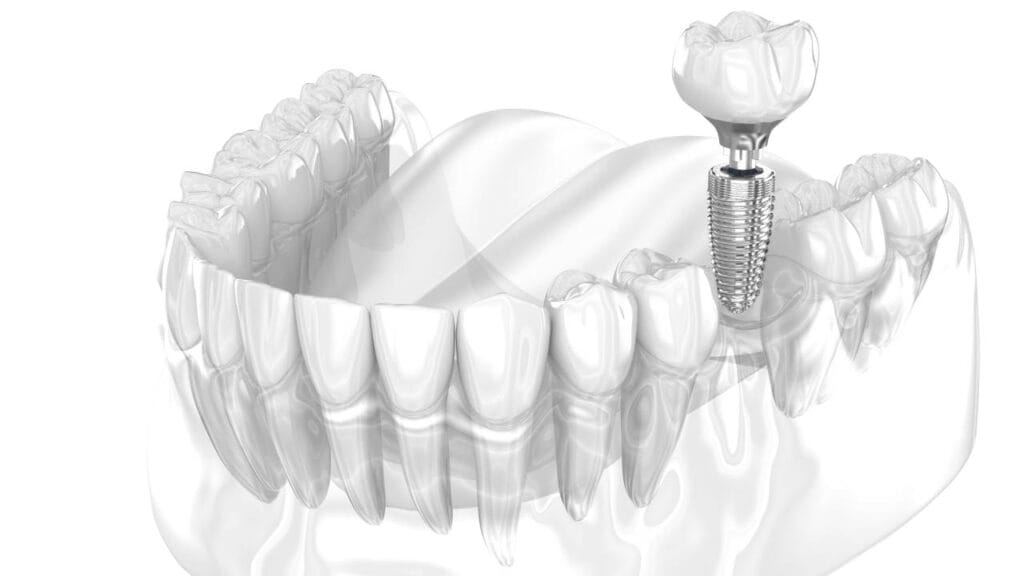 Sakarya Elbirlik Diş Polikliniği implant ve porselen diş tedavisi aşamalarını gösteren 3D medikal animasyon video kapak görseli.