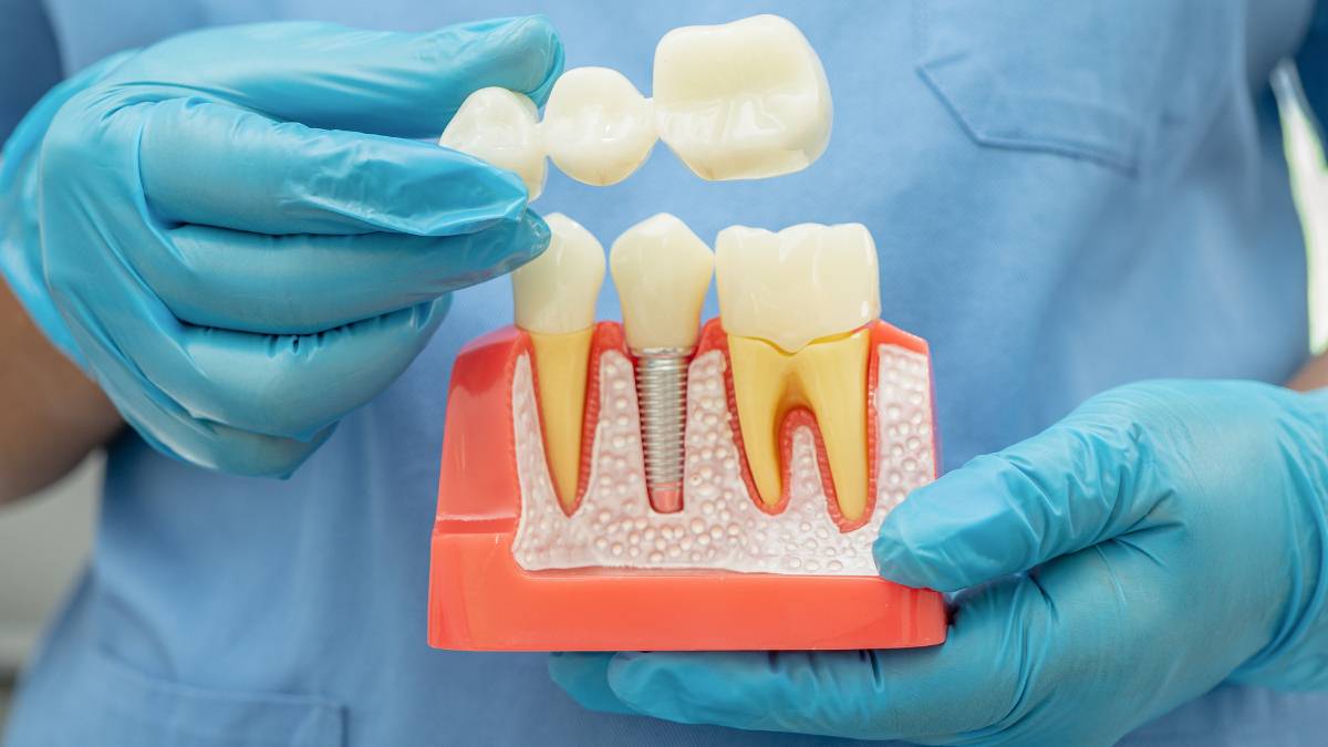 Eksik diş tedavisinde çene kemiğine yerleştirilen yapay diş kökü (implant) ile geleneksel köprü protez anatomisinin dental model üzerinde detaylı karşılaştırması