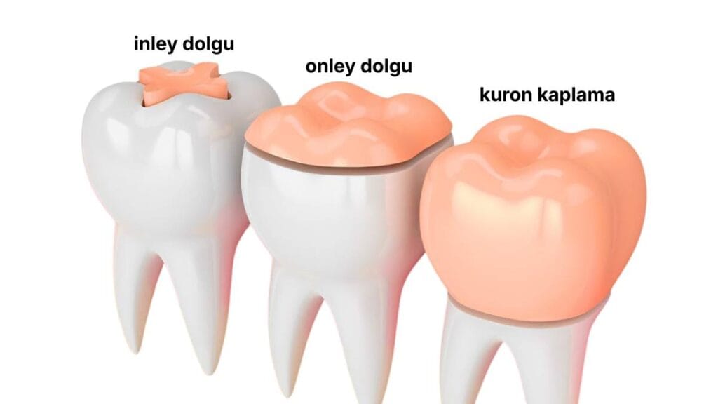 Sakarya diş kliniğinde uygulanan estetik restorasyon türleri: Diş dokusundaki hasar miktarına göre tercih edilen İnlay dolgu, Onlay porselen dolgu ve Kuron diş kaplama arasındaki kapsama alanını gösteren karşılaştırmalı şema.