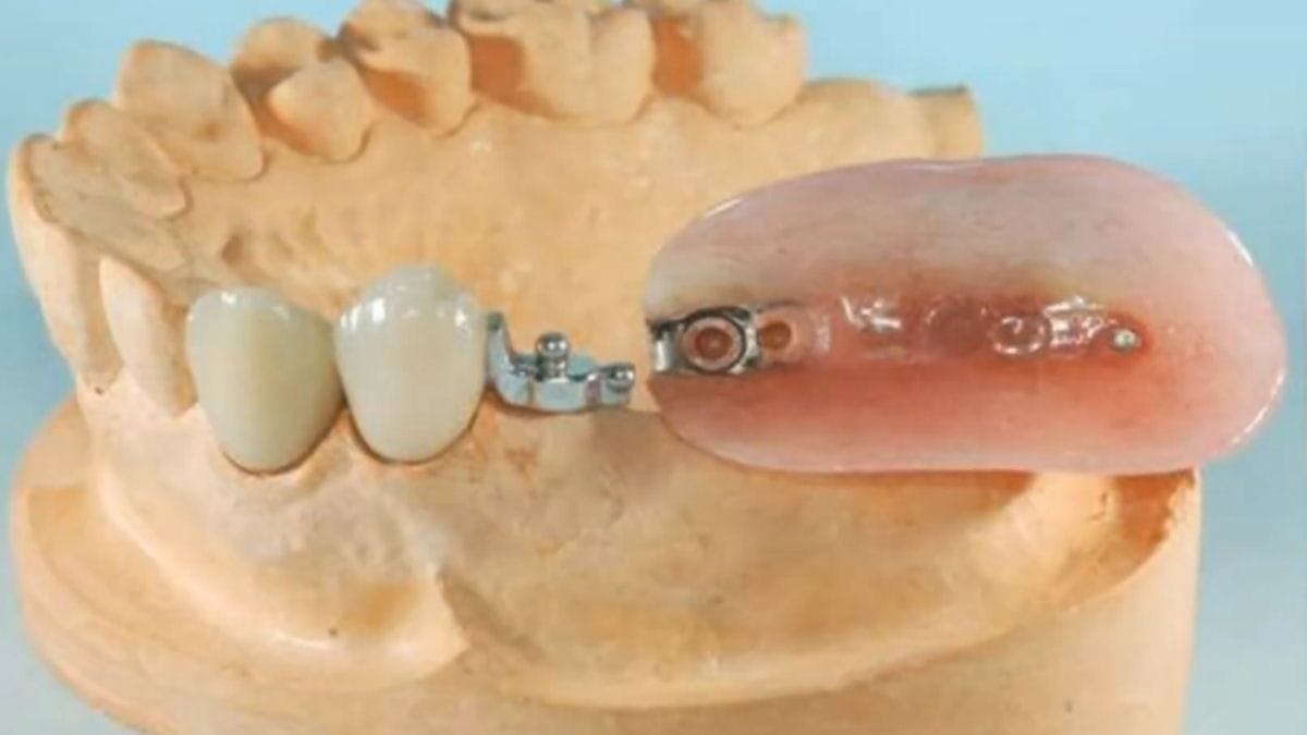 Estetik kaygısı olan hastalar için tasarlanan, metal kanca içermeyen ve sürgü sistemiyle tutunan porselen destekli çıtçıtlı diş protezi modeli