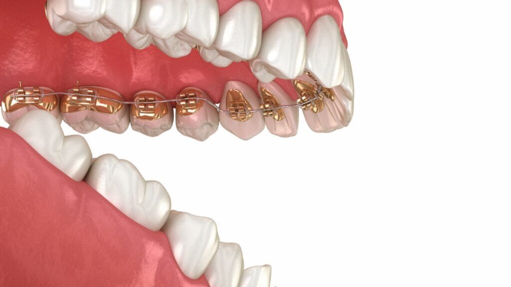 Sakarya ortodonti kliniğinde dişlerin arka yüzeyine uygulanan lingual braket (gizli diş teli) sisteminin 3D animasyon video kapak görseli.