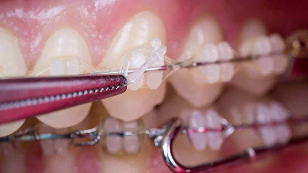 Sakarya ortodonti kliniğinde diş yüzeyine uygulanan, diş rengiyle uyumlu porselen (seramik) braketlerin yakından görünümü.