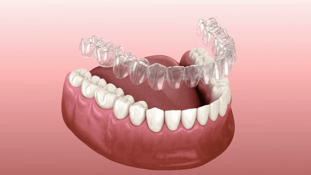 Sakarya diş kliniğinde şeffaf plakların (telsiz diş düzeltme) dişlere nasıl takıldığını ve çıkarıldığını gösteren 3D animasyon video kapak görseli.