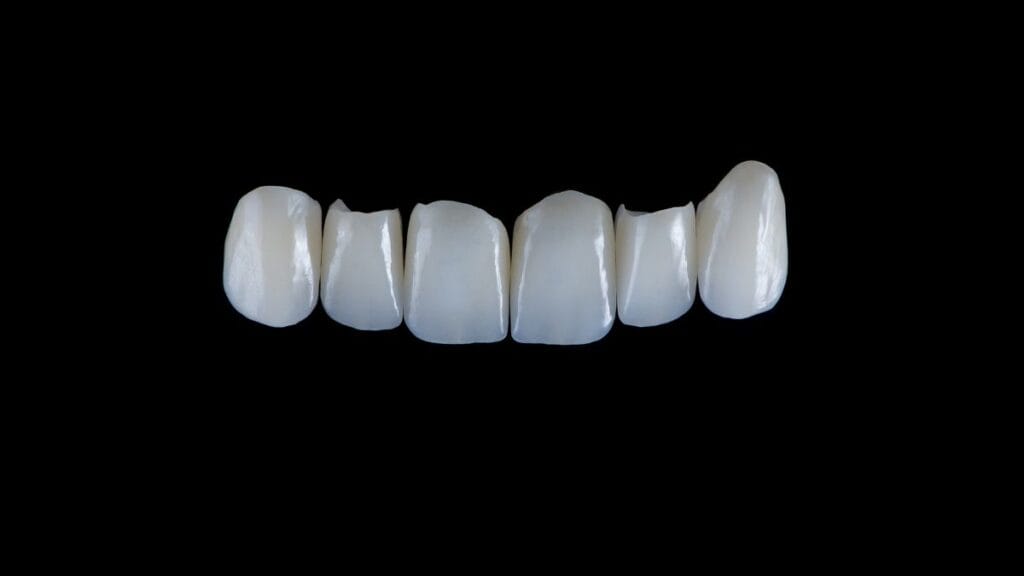 Sakarya diş kliniğinde uygulanan, metal altyapı içermeyen, ışık geçirgenliği yüksek ve diş etiyle tam uyumlu monolitik zirkonyum diş kaplamaları.